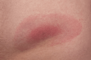 come riconoscere puntura di zecca