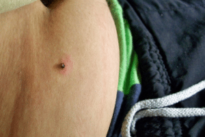 conseguenze puntura zecca